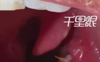 男子竹签卡喉误以为刀片嗓：吃8天药越吃越严重